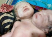 পিরোজপুরে দুই মাথাওয়ালা শিশুর জন্ম
