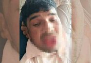 কামড়ে প্রমিকের জিহ্বা ছিঁড়ে ফেললেন তরুণী