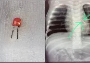৯ মাসের শিশুর ফুসফুস থেকে বের করা হলো এলইডি বাল্ব