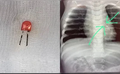 ৯ মাসের শিশুর ফুসফুস থেকে বের করা হলো এলইডি বাল্ব